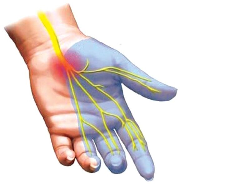 Taubheit der Hand mit Osteochondrose