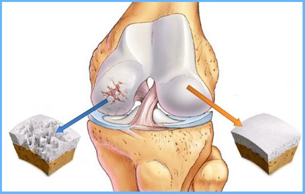 Arthrose des Kniegelenks