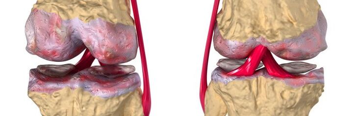 Gesundes Gelenk und Arthrose des Kniegelenks