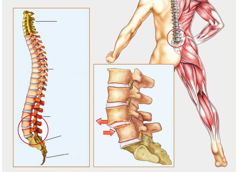 gesunde und kranke Wirbelsäule