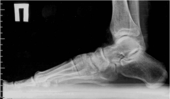 Arthrose der Finger und Füße