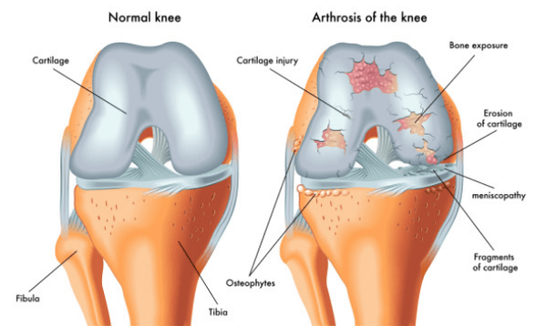 Normales Gelenk und durch Arthrose betroffen