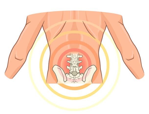 Osteochondrose der Lendenwirbelsäule